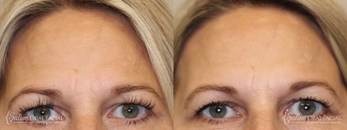 BOTOX® Saline, MI | Saline OMS